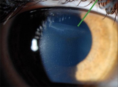 RachelDio's tweet photo. The second ugly truth about Lasik Complications. https://t.co/p4Xf4Y0svO

#lasikcomplications #lasik #eyeproblems https://t.co/Ne7Uba4Mqq