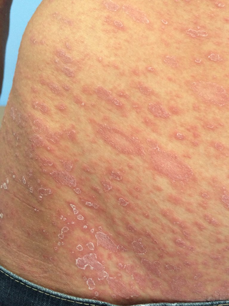 Masc 14años sin APP; 15 días de evolución con lesión satélite inicial q me llega ya q fue tratado x scabiasis!!