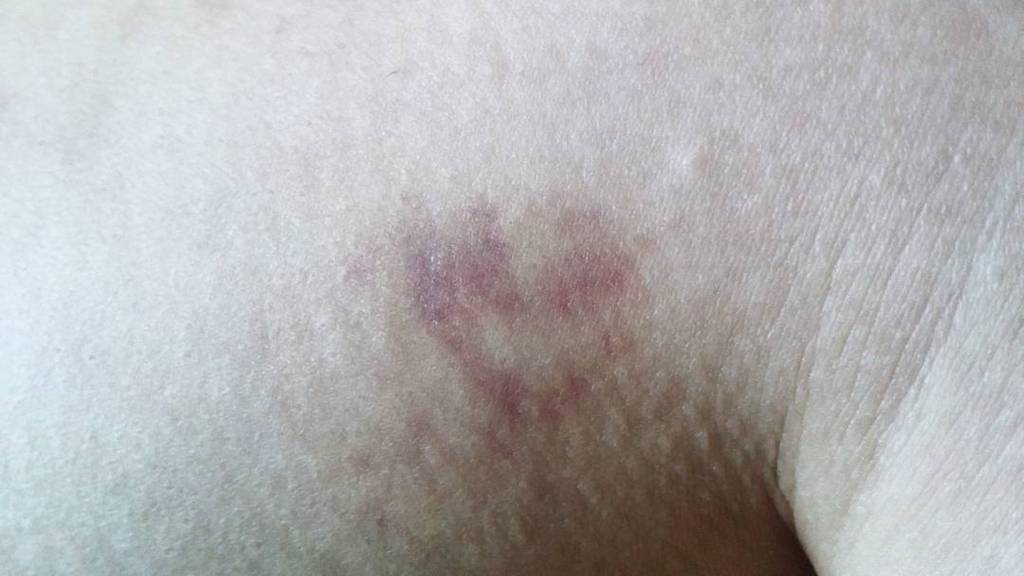 MariaCocinitas's tweet photo. Cuando te gusta tanto #poledance que los moratones tienen forma de corazón #polekisses #polebruises #heartshaped https://t.co/UlhH5PPpE0