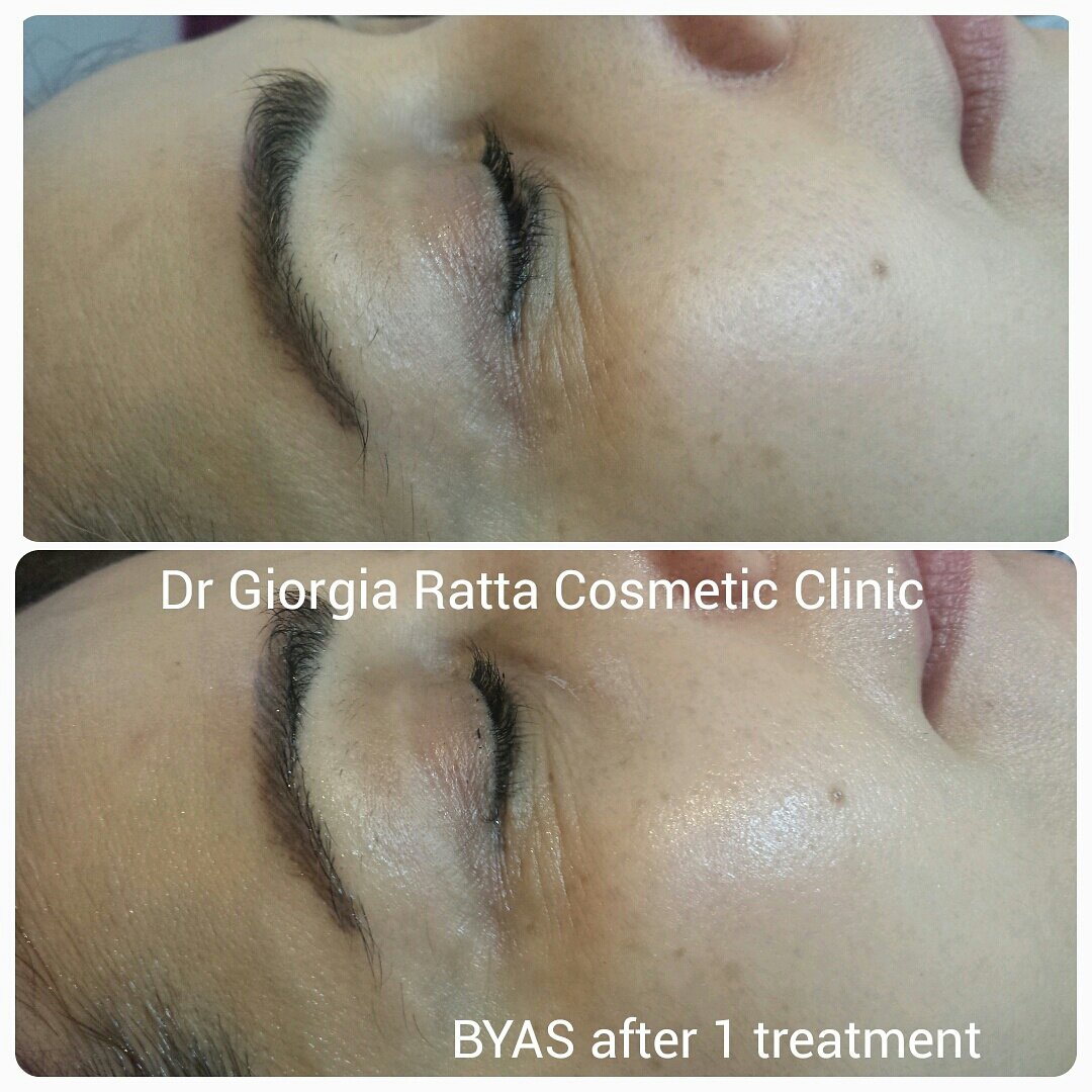 drGiorgiaRatta's tweet photo. Amazing results with the #BYAS #FaceLifter machine!Nothing to envy to professional expensive machines!#rejuvenation https://t.co/wWKwlSXt8t