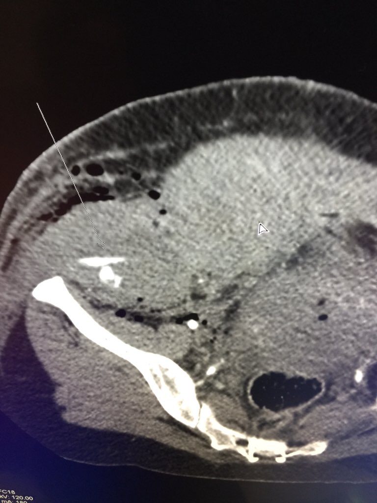 MountSinaiIR's tweet photo. Live from @MountSinaiNYC West #IRad: post C-section bleed: double  
PSA!

#Trufill #justglueit @bonesz https://t.co/AjMgS3C8p0