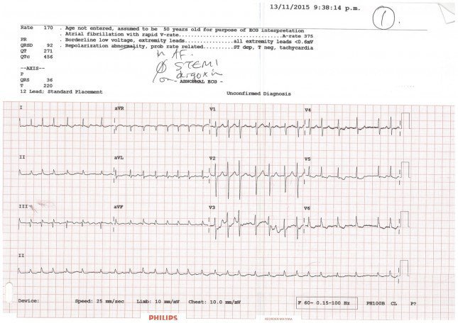 Engage your brain when reading ECGs emtutorials.com/2015/11/engage…