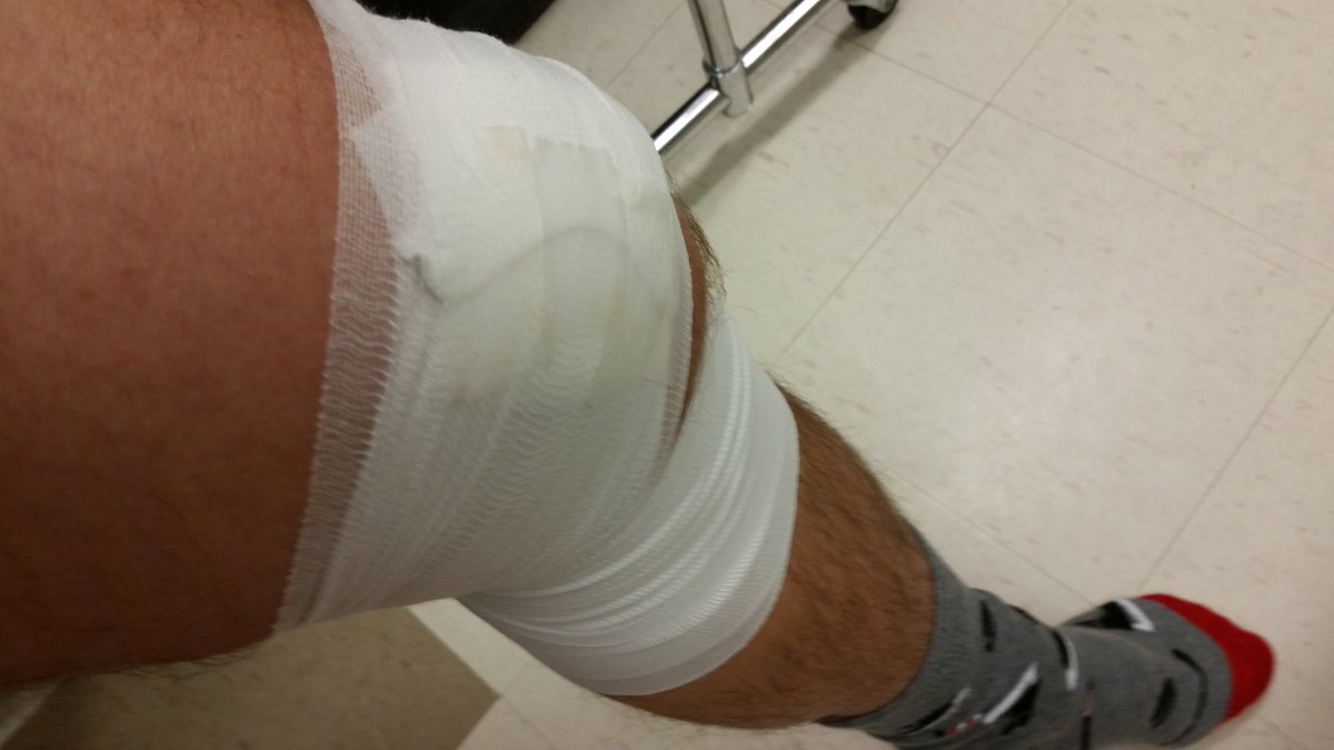 derekc90's tweet photo. 3 out of 4 came out leaking. I'm the only one needing stitches. #scars #jungle #skatesaresharp https://t.co/aV0GSTi3Hf
