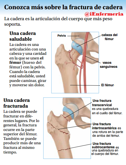 ienvzla's tweet photo. Fractura de Cadera... Conoce mas! #Enfermeria #Salud #Fractura #Cadera https://t.co/XRy7JpSUKL