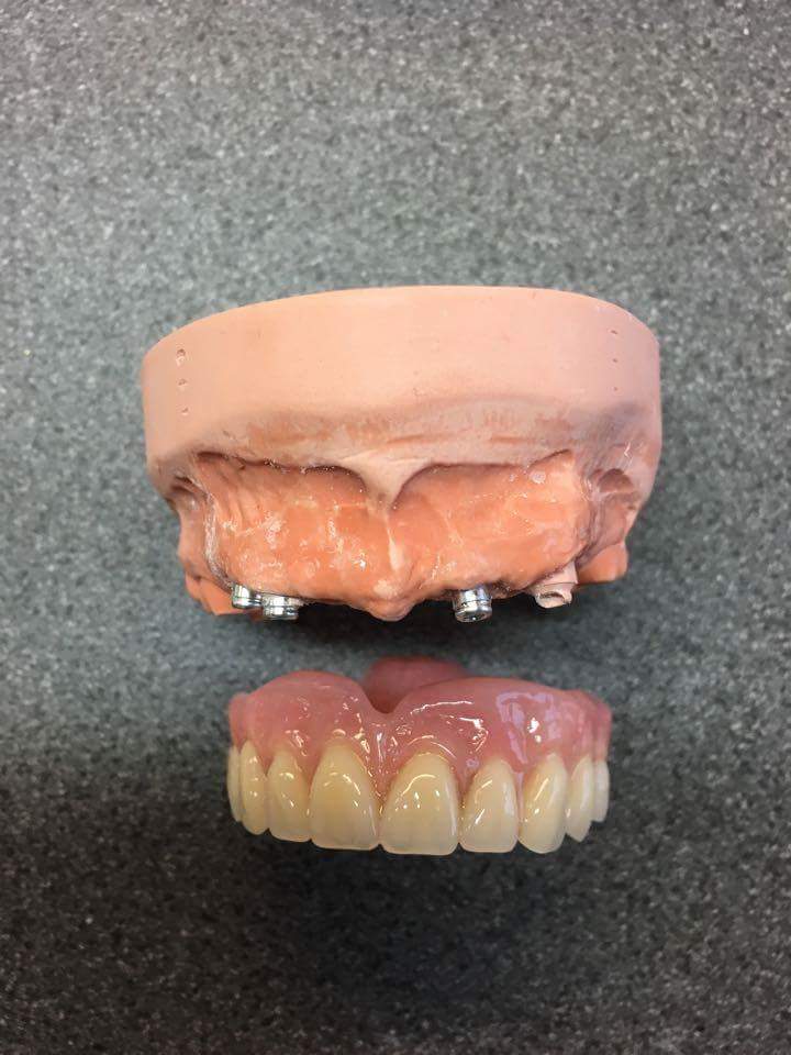 OswestryDentLab's tweet photo. #straumann retained implant dentures with #schottlander natura teeth https://t.co/Pl67QzvgE4