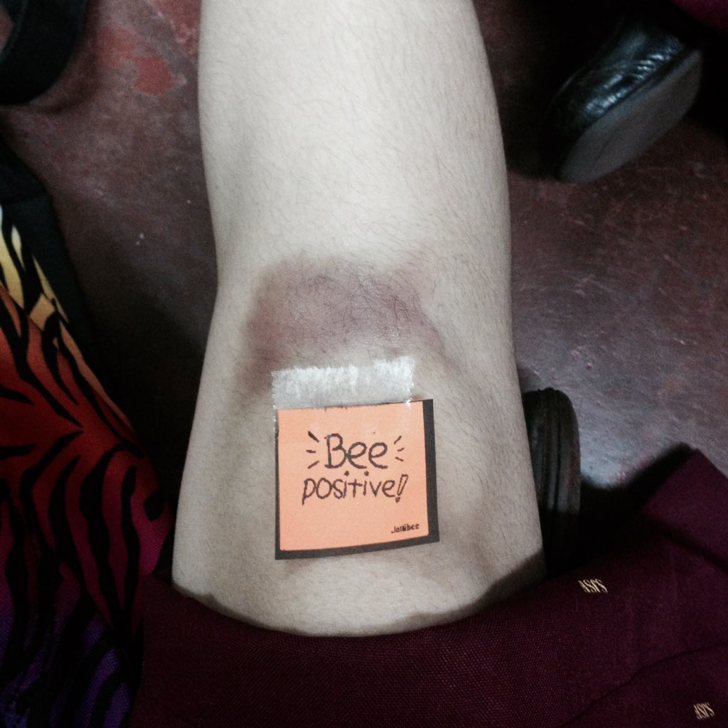 CaraamelT's tweet image. when u have pasa on ur leg &amp;amp; knee 😭
dis is wat i get for sliding on the floor HAHA :-(( everythings hurts 😩 #VBprobs