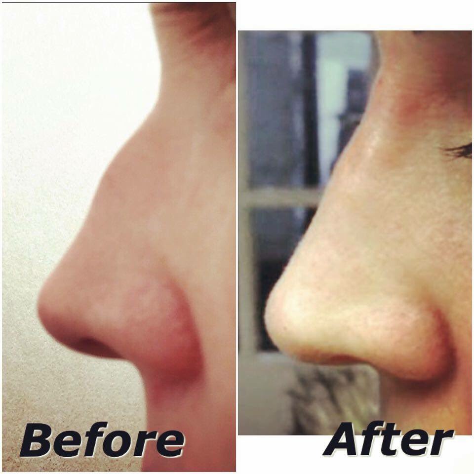 btoxclinics's tweet photo. #noseaugmentation for one of our gorge patients yesterday. Fast, cost effective, safe & no down time #nosey https://t.co/vnY9nKkZr8