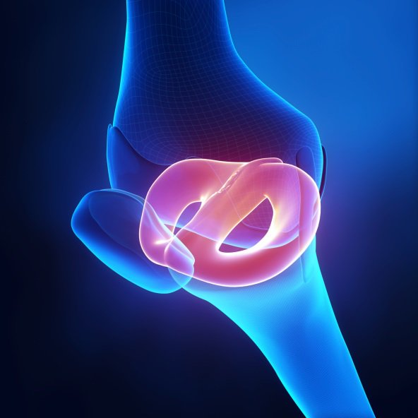QuentinPIRET's tweet photo. Meniscus : to treat or not to treat at the time of an ACL surgery, that's the question ! https://t.co/H16MnzIjUk https://t.co/5cyKvhgIGa