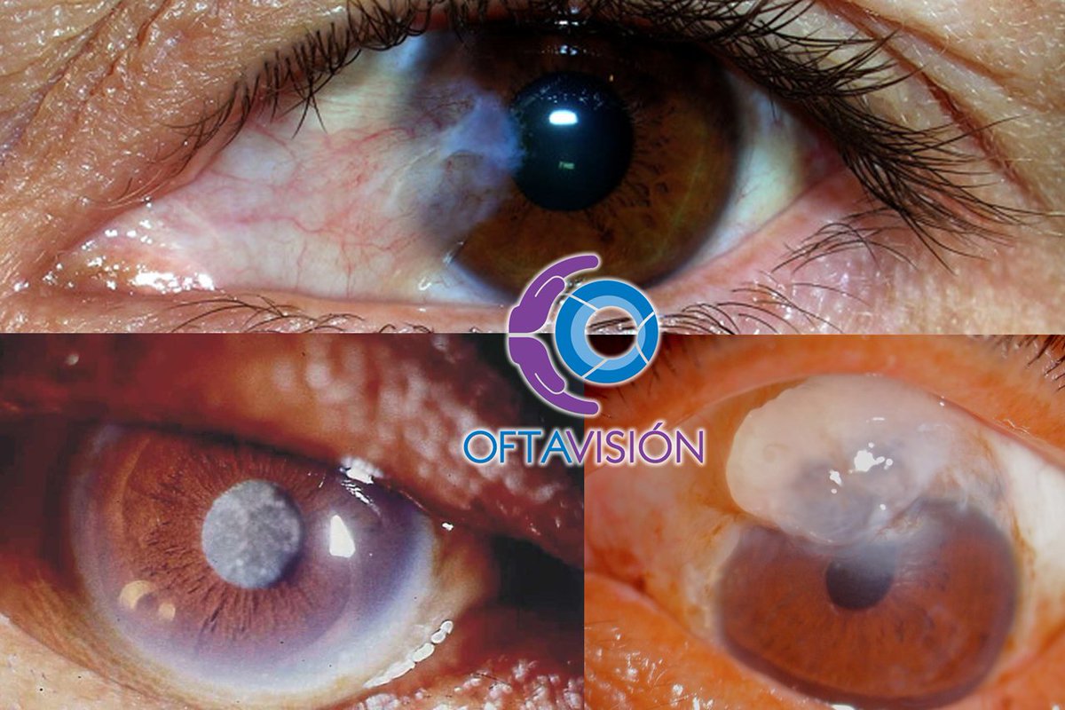 Una catarata ocurre cuando el cristalino, el “lente” del ojo se nubla, afectando la visión.
oftavision.com.mx/padecimientos/…