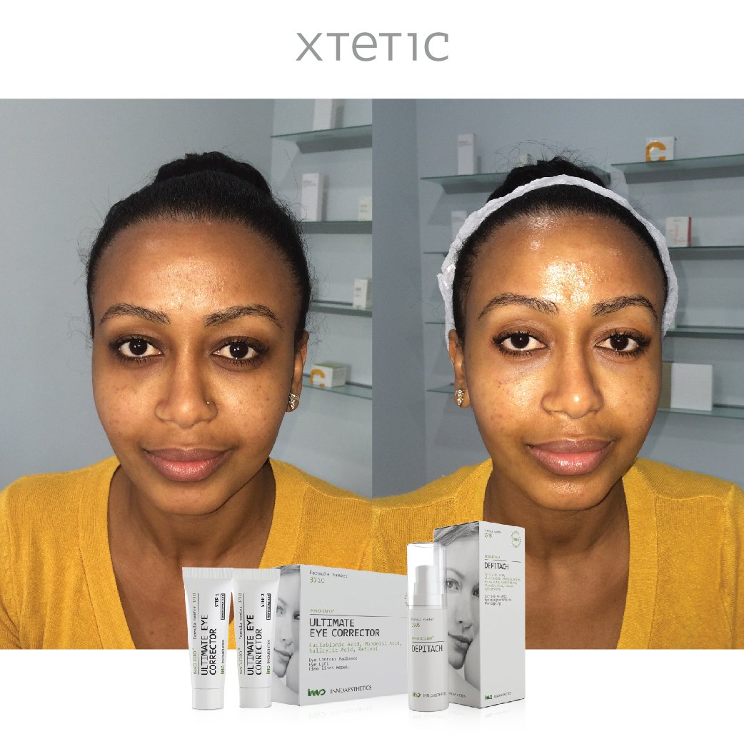 Innoaesthetics's tweet photo. Amazing results after getting an Ultimate Eye Corrector Treatment! #dark #circles   https://t.co/4ARJ3indR2 https://t.co/B84SGeJBAb