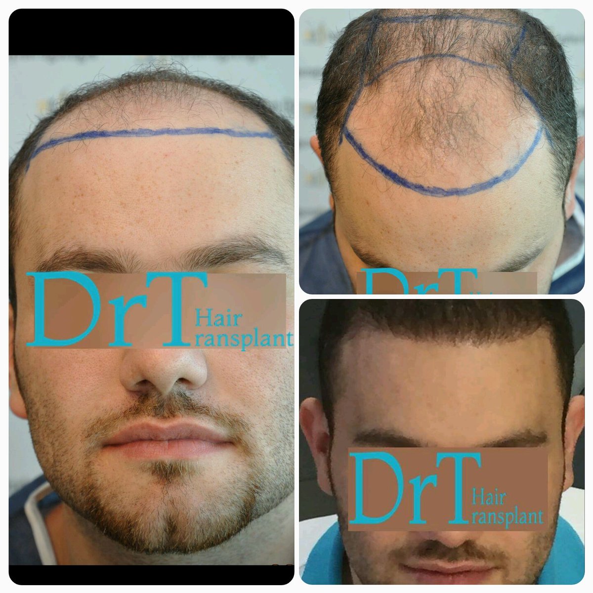 tayfunoguzoglu's tweet photo. للحصول على احسن النتائج في زراعه الشعر اتصل بنا على الواتسب ٠٠٩٠٥٣٤٠٦٥٦٨٢٩ https://t.co/TRqM4zCpTQ