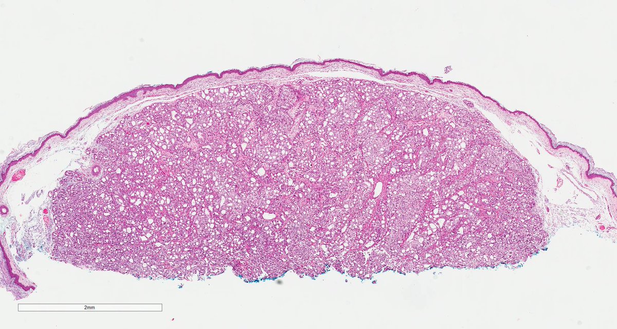 Gleason4plus5's tweet image. Unusual, #prostatecancer metastasis to the skin. Have only seen it once. #pathologists #pathology #gupath