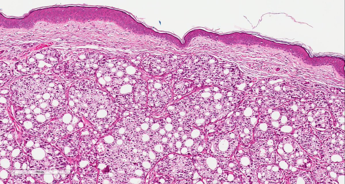 Gleason4plus5's tweet image. Unusual, #prostatecancer metastasis to the skin. Have only seen it once. #pathologists #pathology #gupath