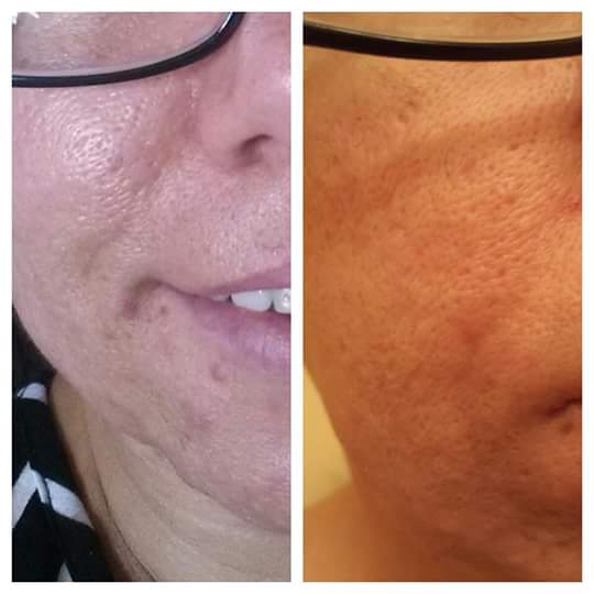 Un poco mas de 2 meses usando #Nerium los cambios son increibles #YudiPedraza Resultado Real https://t.co/c2ab02R9pn https://t.co/sC6VTOBS4y