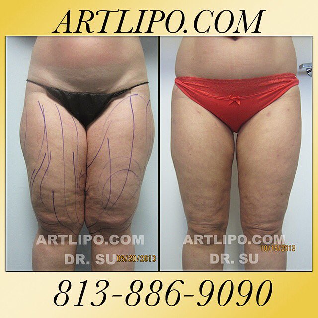 Artlipo's tweet photo. #Thigh #Slimming #Liposuction by #DrSu #Tampa #Orlando #Sarasota. #Artlipo #lipo #fitness https://t.co/8dyhwZ2q2S https://t.co/YPsccu67I7