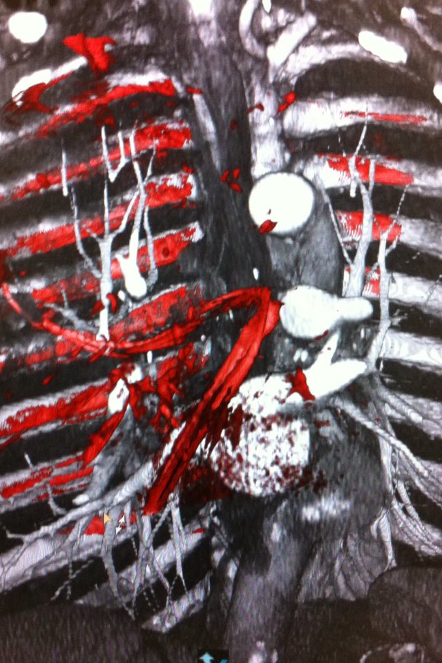 fermgmez's tweet photo. Nice performance on pulmonary artery embolisation using #XPerCT, image overlapping and 3D roadmap at @HospitalLaFe https://t.co/ogRkz49HCQ