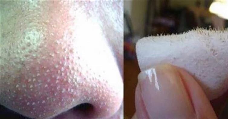 "COMO REMOVER CRAVOS DO NARIZ USANDO TRÊS COISAS QUE TODOS TEM EM CASA goo.gl/F2HAi4 "