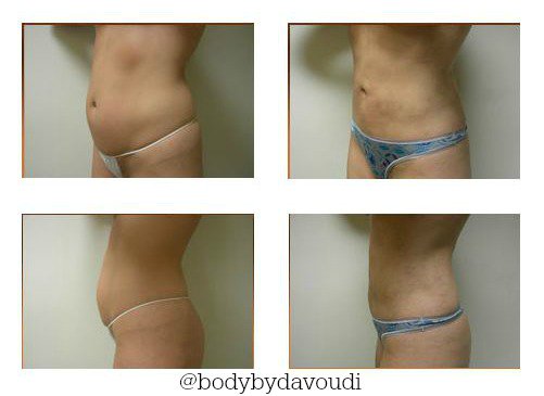 DrDavoudi's tweet photo. #Liposuction is growing in popularity in the US. Call (770) 418-1234 to find out more on this procedure! https://t.co/jjbvIt2tD2