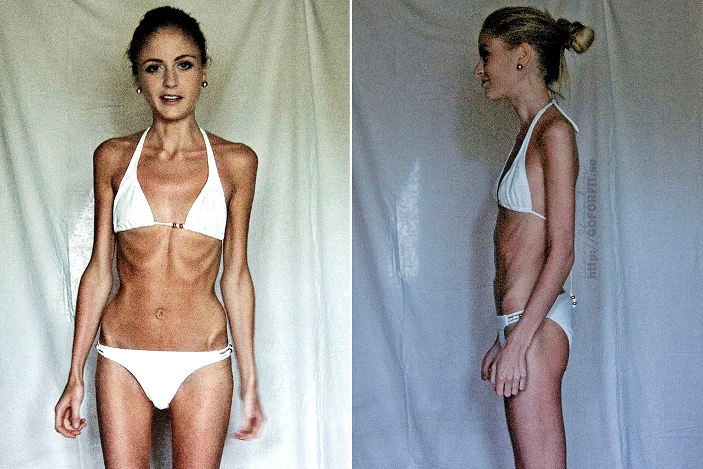 Anorexia Pictures Of Women
