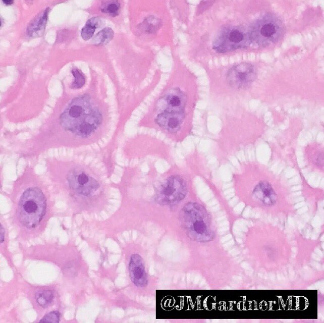 JMGardnerMD's tweet image. Squamous cell carcinoma w beautiful  intercellular bridges (desmosomes) #pathology #Dermpath