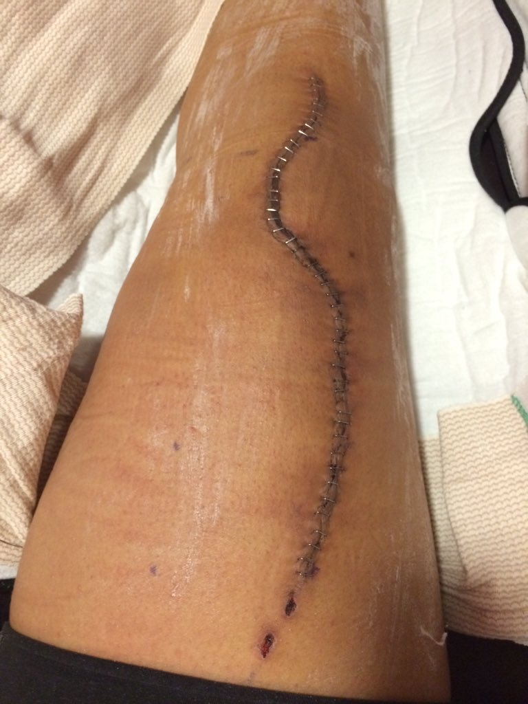 TrapGodLeya's tweet photo. Cancer isn't beating me all it did was decorate my leg and give me a new hair style 👴🏽 #gottakeepfighting https://t.co/BjnTj55ut0