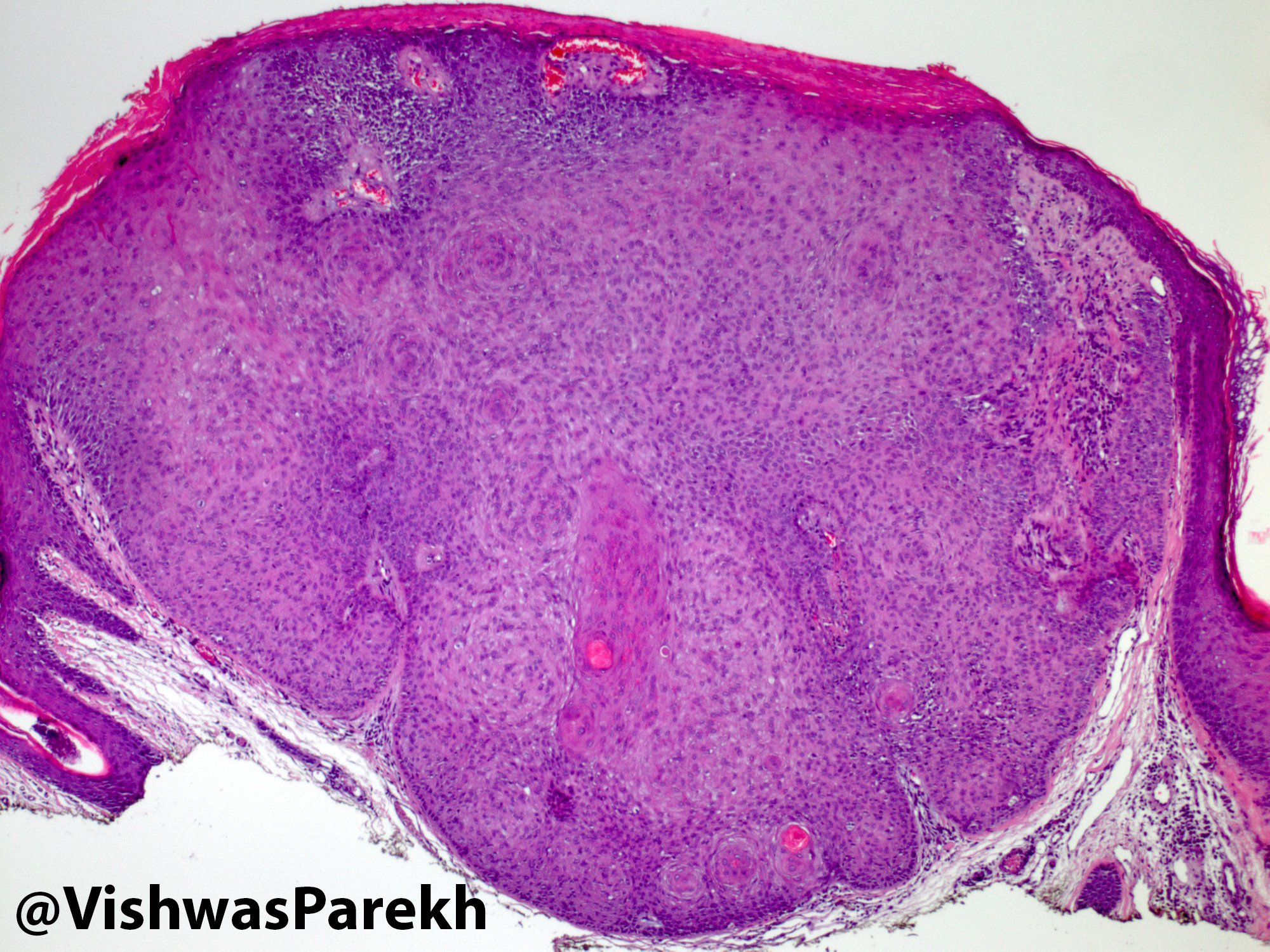 Follicular Keratosis Seborrheic Keratosis Patholines.org