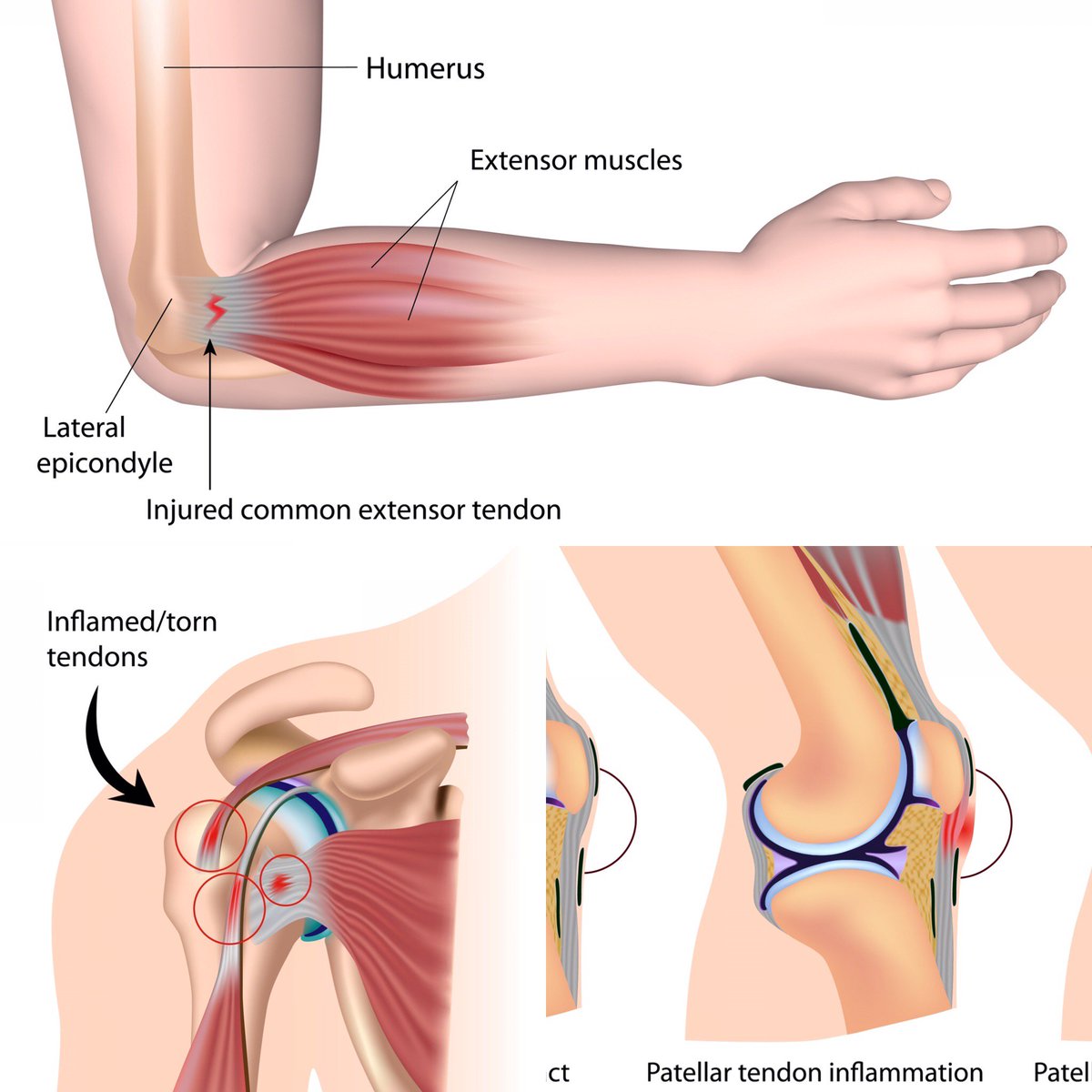 TotalOrthopedic's tweet photo. Tendonitis: What is it and how can it be treated?
https://t.co/bopvUfdBil 
#tendonitis #tendinosis #tenniselbow https://t.co/1CVYPa2rmv