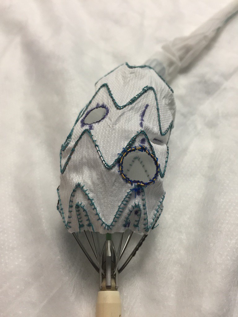 Today we did the first 3v physician modified endograft for BOLTON on the planet. Perfection using our PM technology!