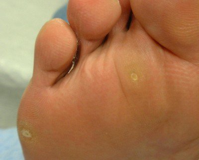 Goma New Post 魚の目ができてしまう原因と自分で治す方法 T Co Gnbwl0rw9qごまろぐ T Co 7q317pn9ds