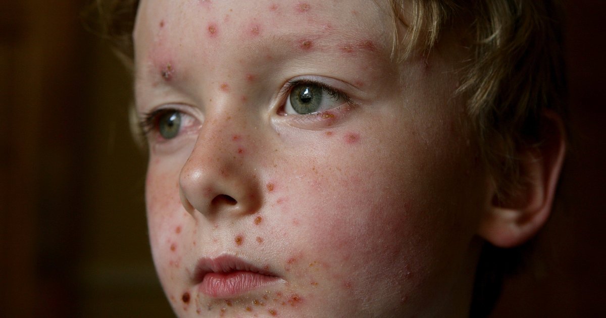 HuffPost's tweet image. Low vaccination rate at Australian school leads to chicken pox outbreak huff.to/1NQtplA