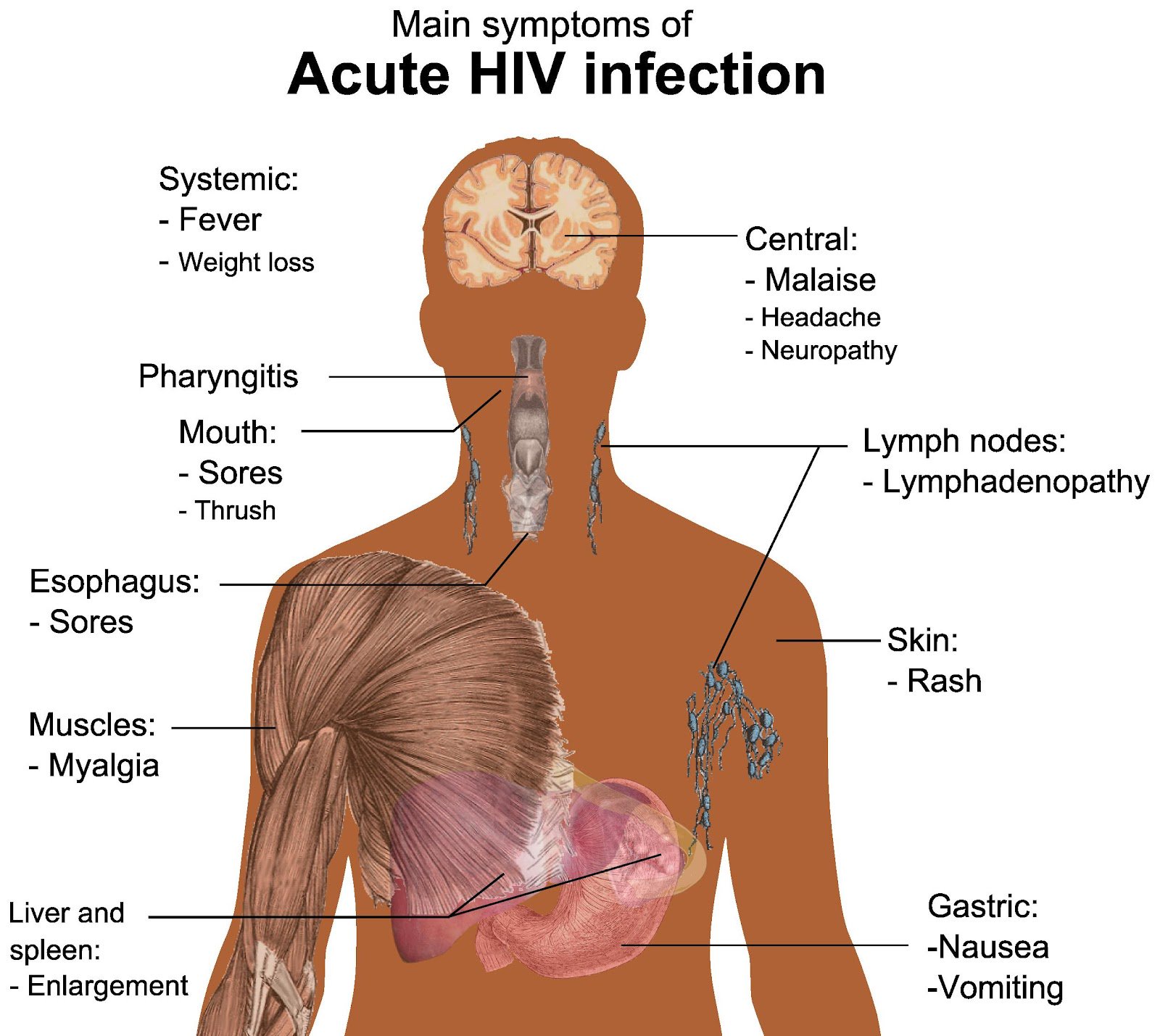 SS on X: "Main symptoms of acute #HIV #infection. https://t.co/UYc6Etrd1q"  / X