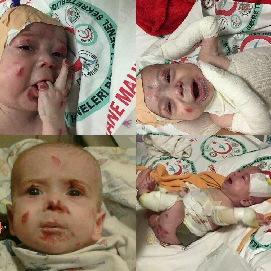 HASAN HÜSEYİNE HASTANE ARIYORUZ

GÖREN PAYLAŞSIN VE İMKANI VARSA YARDIMCI OLSUN LÜTFEN

#HasanaHastaneArıyoruz