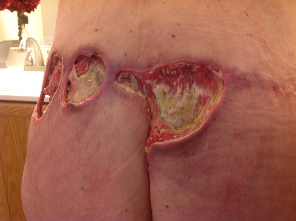 goremortem's tweet photo. Vamos alla una lipo infectada https://t.co/nZGqOIvP3n