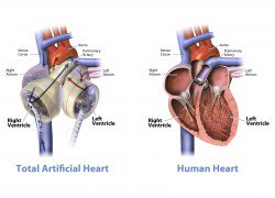 KickAssTwee's tweet image. One day soon mechanical hearts could replace our f... bit.ly/1Q7lUf5 #KickAss | twibble.io