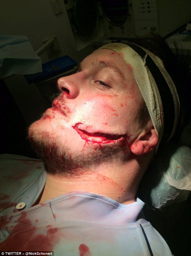 SARugbymag's tweet photo. PHOTO: Worcester prop @NickSchonert required 40 stitches after suffering this facial injury against Saracens. https://t.co/UOYVs3xVXn