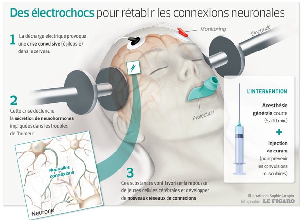 LeFigaro_Sante's tweet photo. L'électroconvulsivothérapie fait des étincelles contre la dépression sévère >>https://t.co/Xn9h3ofwCu https://t.co/Db408Z7IW4