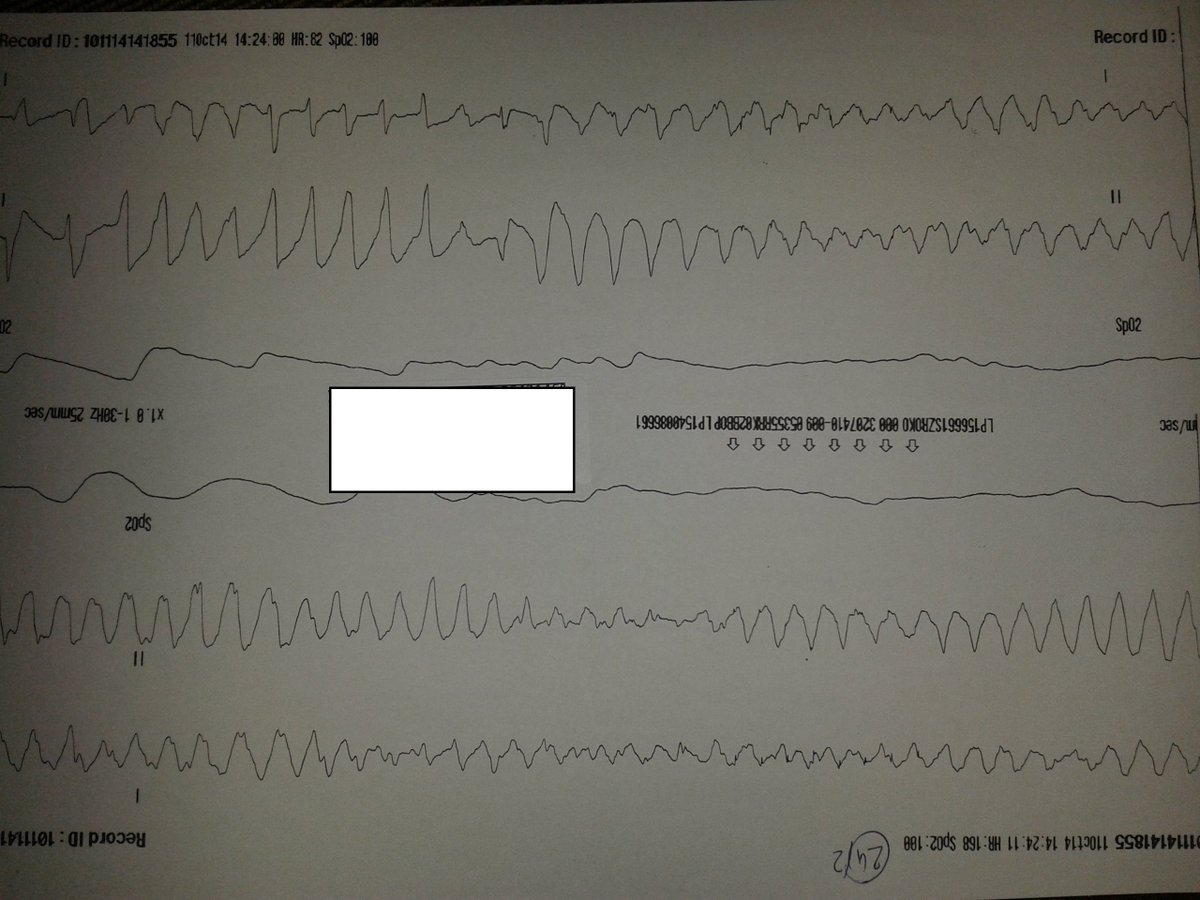 dr_huszar_timea's tweet photo. @edjamesburns Hello James! A piece of really nice ecg from my collection! :) https://t.co/6qaqLfyiHl