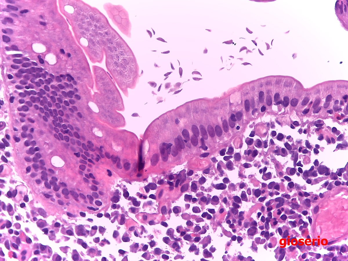 giardia duodenal biopsy