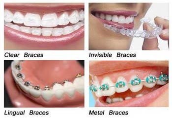 Did you know approximately 4 million people have braces on their teeth right now in all different forms?!
