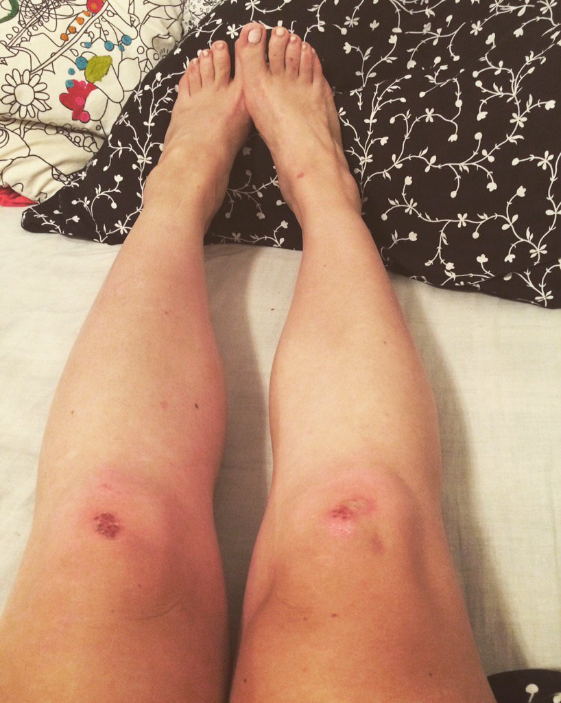 Waardig Gloed ventilator Laura Kennington on Twitter: "Legs looking pretty mangled from training. An actual blister on my knee is definitely a first! #matburn #BJJ https://t.co/q8099mNJwH" / Twitter Waardig Gloed ventilator Laura Kennington on Twitter: "Legs looking pretty mangled from training. An actual blister on my knee is definitely a first! #matburn #BJJ https://t.co/q8099mNJwH" / Twitter