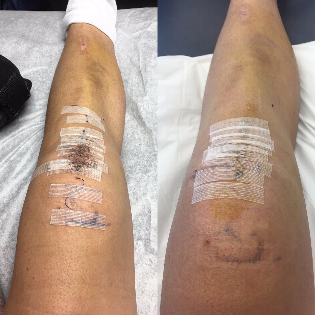 MadiGarrigan's tweet photo. My Stitches!! πβοΈπ₯ #nextstepvolleyball #onlygettingbetterfromhere https://t.co/0hzXkSXDcQ