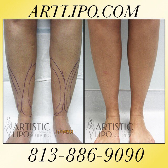 Artlipo's tweet photo. #Cankles, #Ankles, #Calves #Liposuction #Tampa #Orlando #Sarasota #Fl. #Legs #lipo #Artlipo #DrSu #plasticsurgery https://t.co/vCEoIxKh1o
