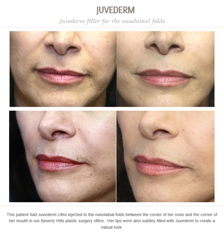DrJonPerlman's tweet photo. This patient had Juvederm Ultra injected to the nasolabial folds between the corner of her nose and her mouth. https://t.co/McNglURkfv
