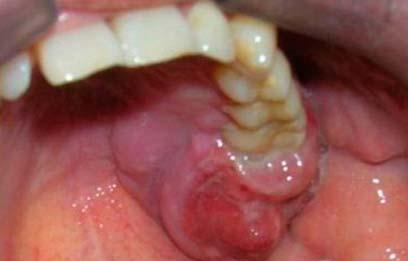 CirujanoOral's tweet photo. "Salud Bucodental ante Cáncer de Cavidad Oral" https://t.co/127DxWr1PN #FelizMartes #Maxiloblog ¿Difundes? Gracias https://t.co/ymbBEARGpp