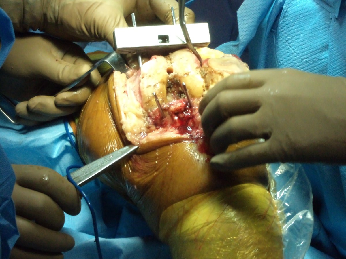 HighwayHospital's tweet photo. Highway Hospital Varanasi total Knee replacement https://t.co/5xPnDuyswp