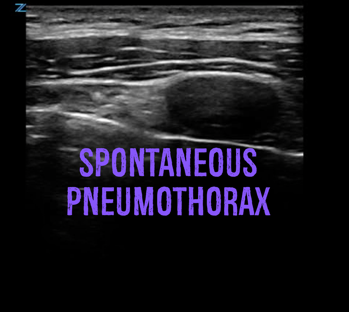 HennepinUS's tweet photo. New post! Spontaneous Pneumothorax -  https://t.co/vvGagNqUMz https://t.co/iR0AehXam5
