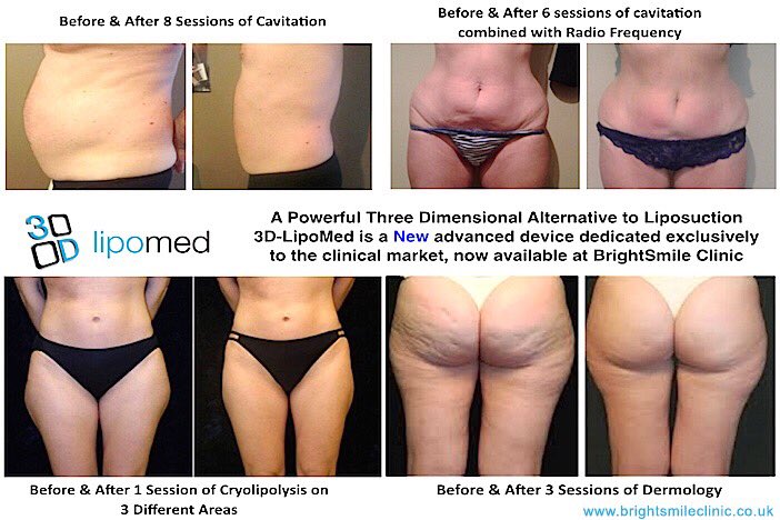 NWWstudios's tweet photo. Amazing results with 3D Lipo Now at #NWWstudios #stasaph BOOK NOW https://t.co/nG0YJfXUem