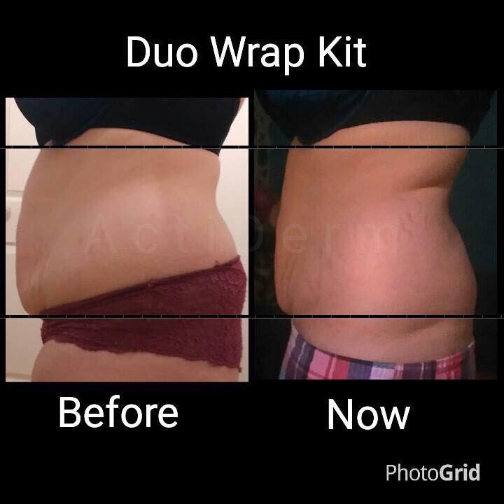 danielle_j89's tweet photo. #LBD too tight? Want to #loseinches you can with our #wrapkits #duowrap #actiderm https://t.co/yX9nqgsOhW https://t.co/bSybpLJE4A
