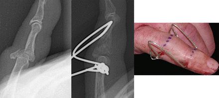 jbjs's tweet photo. This Week in JBJS Reviews—Treating Proximal #Interphalangeal Joint #Fracture-Dislocations https://t.co/QAAsbvNVnt https://t.co/iGoJ8Br4gB