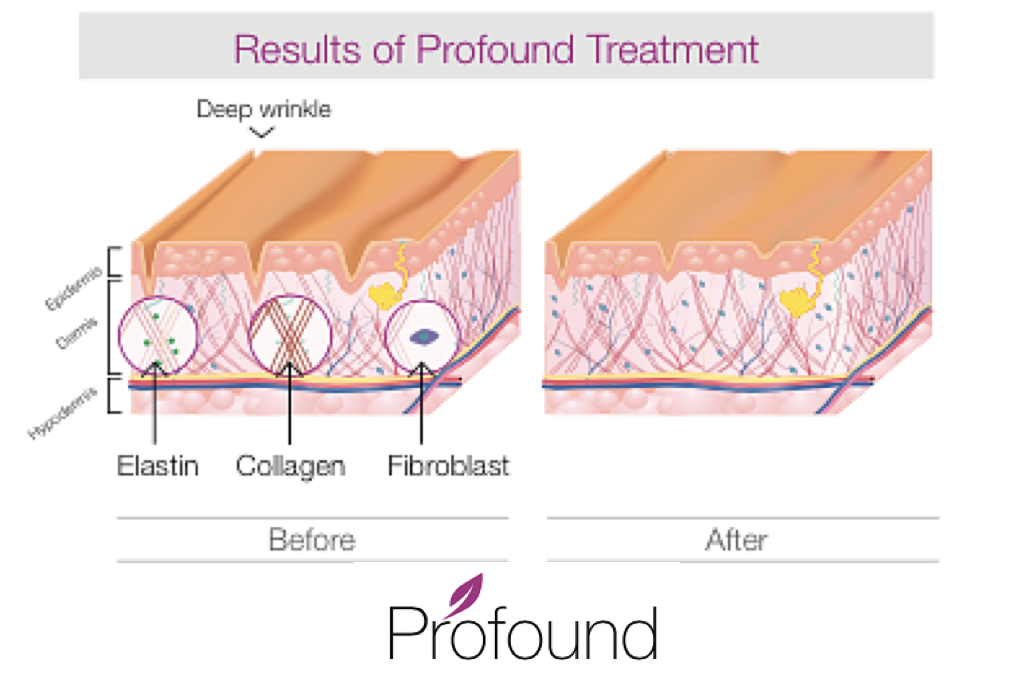 COSMETICMED's tweet photo. The new science of anti-aging targets collagen, elastin, hyaluronic acid #ProfoundLift https://t.co/7RGRgQsOmQ https://t.co/wdovciJkKt